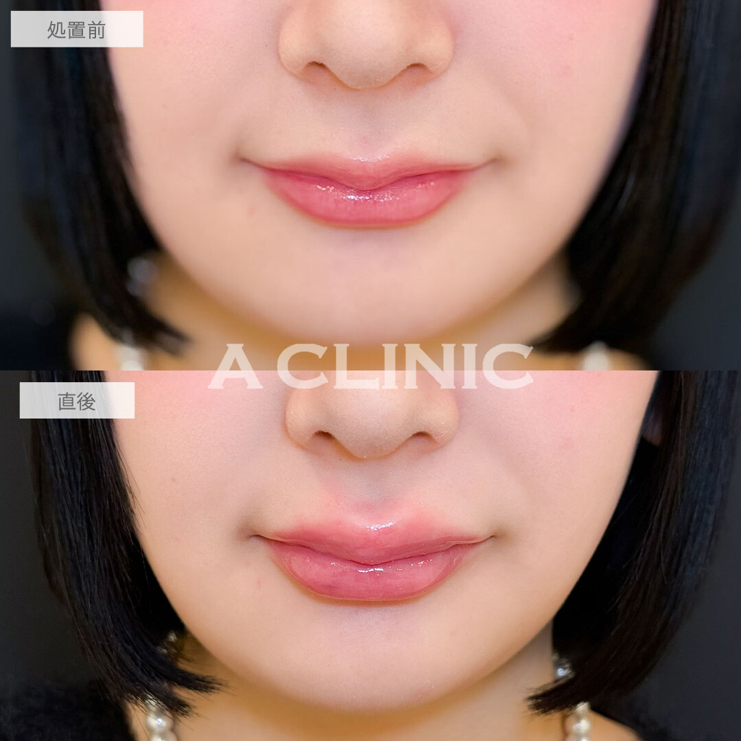 スマイルリップでぷるぷるM字リップになりました！こちら処置前と直後の症例です(20代女性)