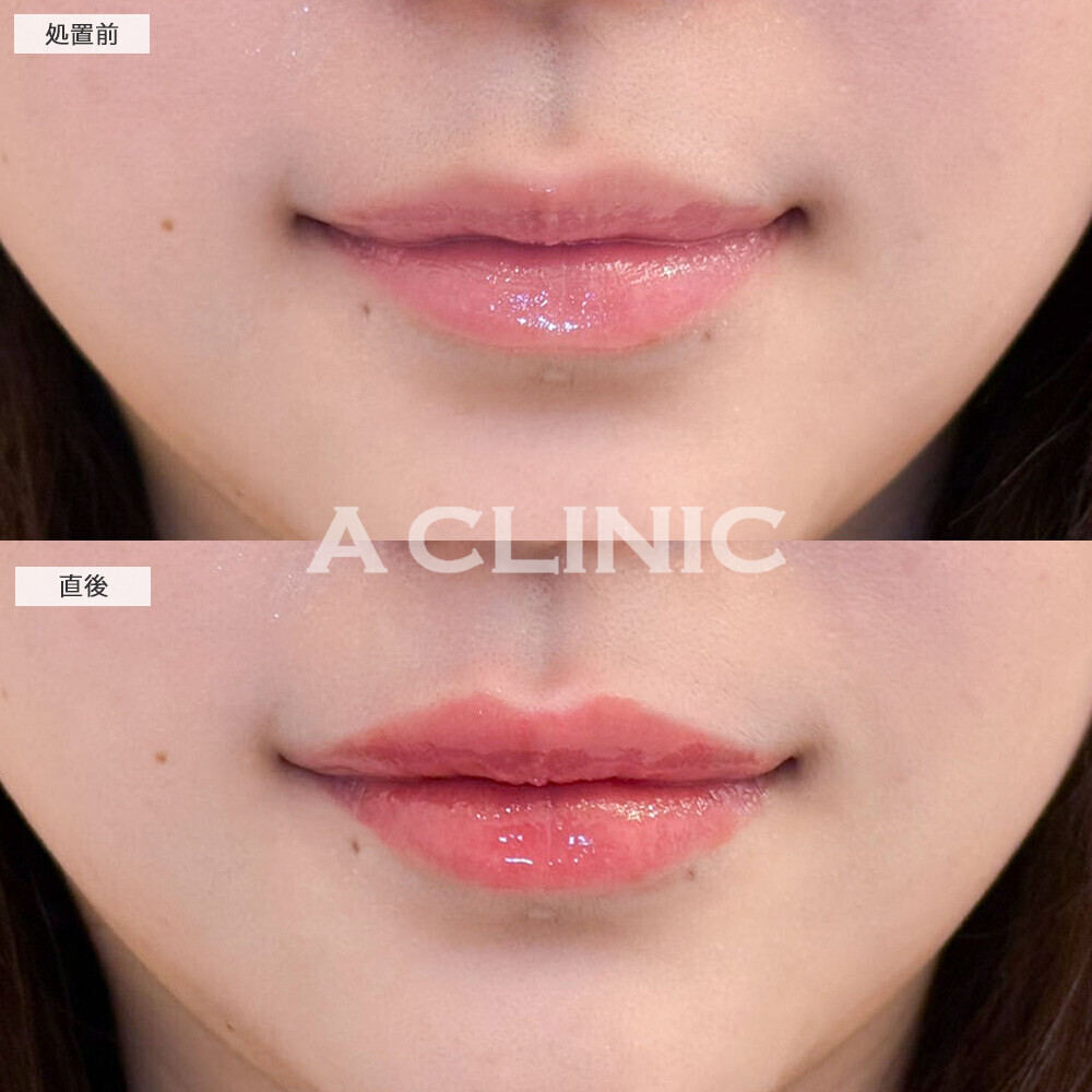 スマイルリップで形と厚さを整えて可愛い唇に！こちら処置前と直後の症例です(10代女性)