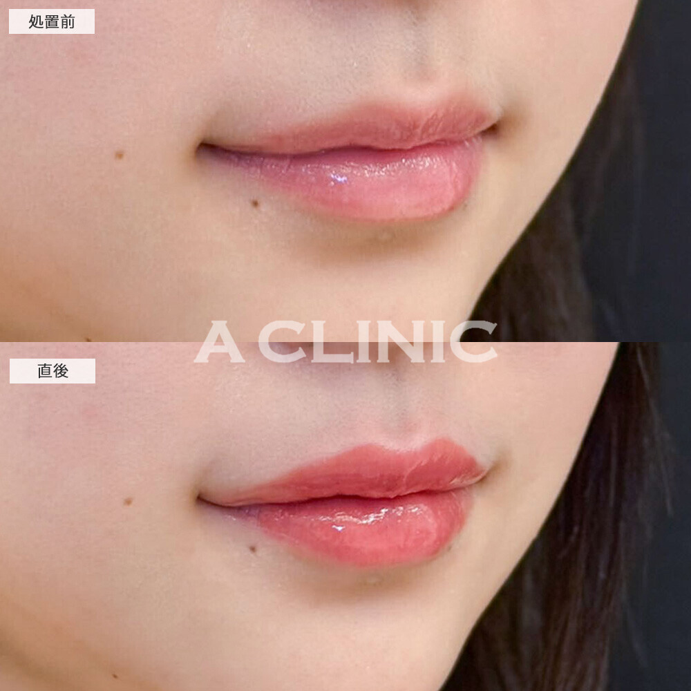 スマイルリップで形と厚さを整えて可愛い唇に！こちら処置前と直後の症例です(10代女性)