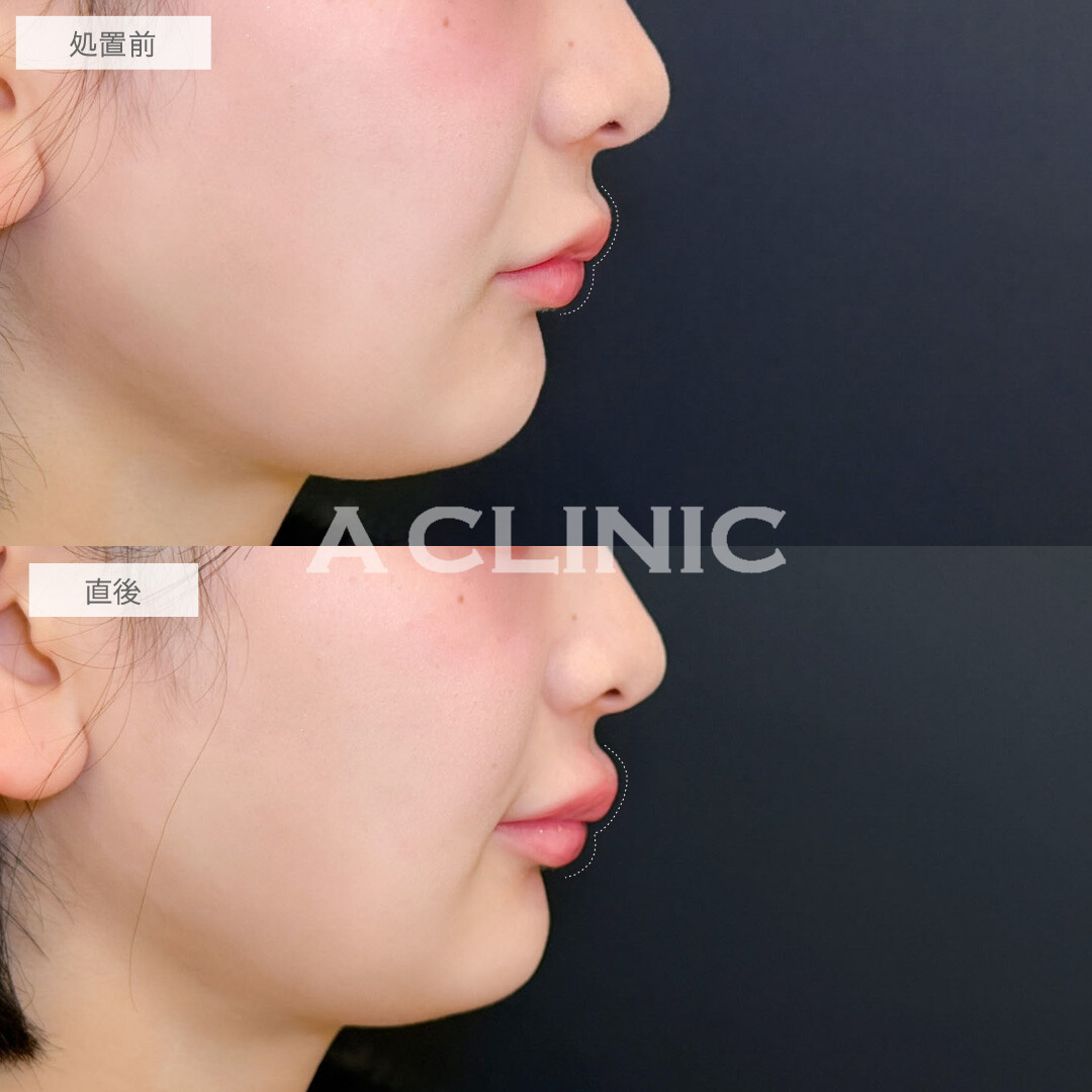 スマイルリップでぷるぷるM字リップになりました！こちら処置前と直後の症例です(20代女性)