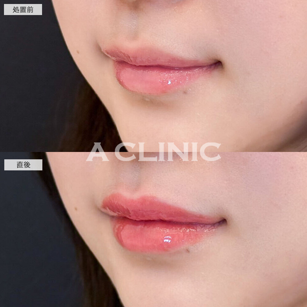 スマイルリップで形と厚さを整えて可愛い唇に！こちら処置前と直後の症例です(10代女性)