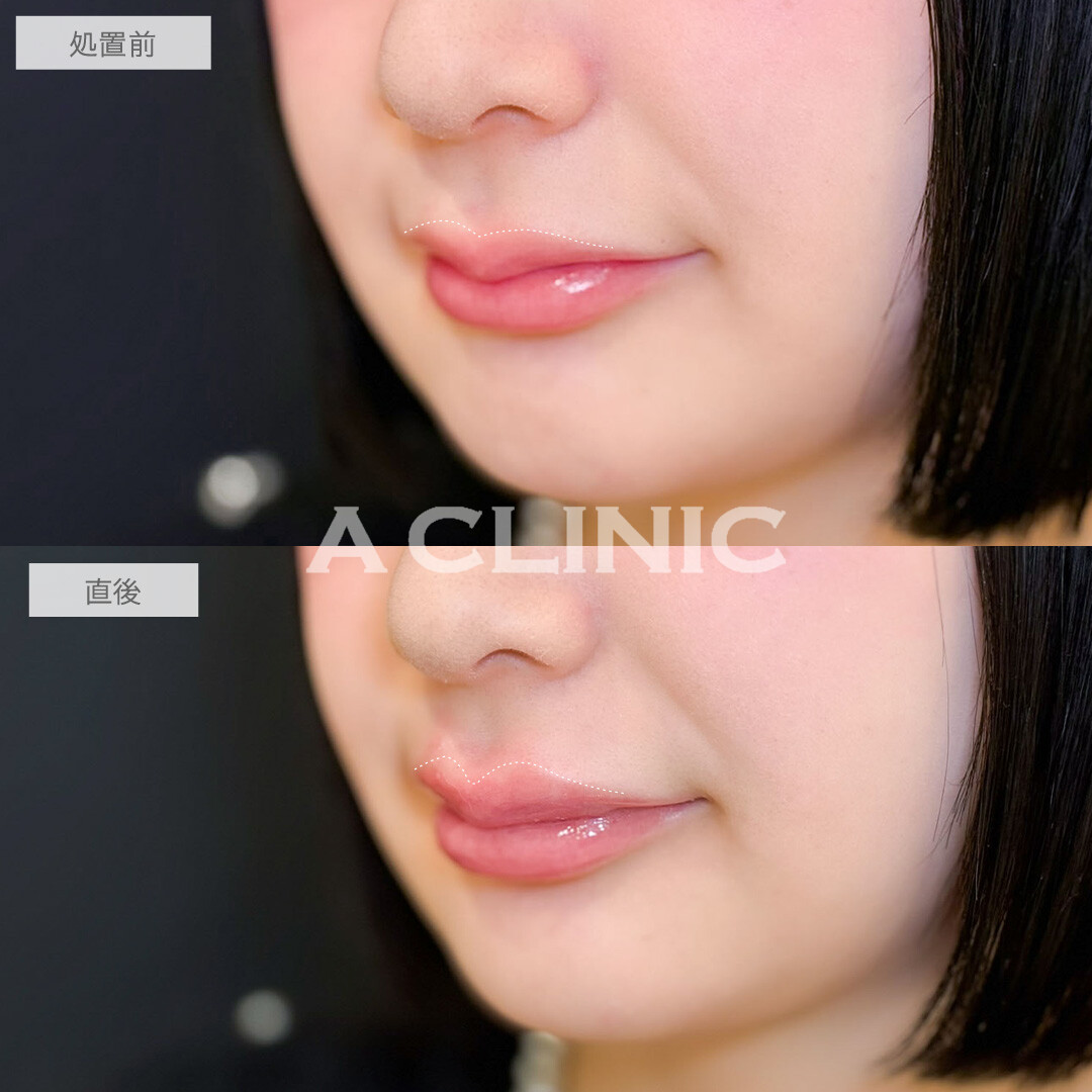 スマイルリップでぷるぷるM字リップになりました！こちら処置前と直後の症例です(20代女性)