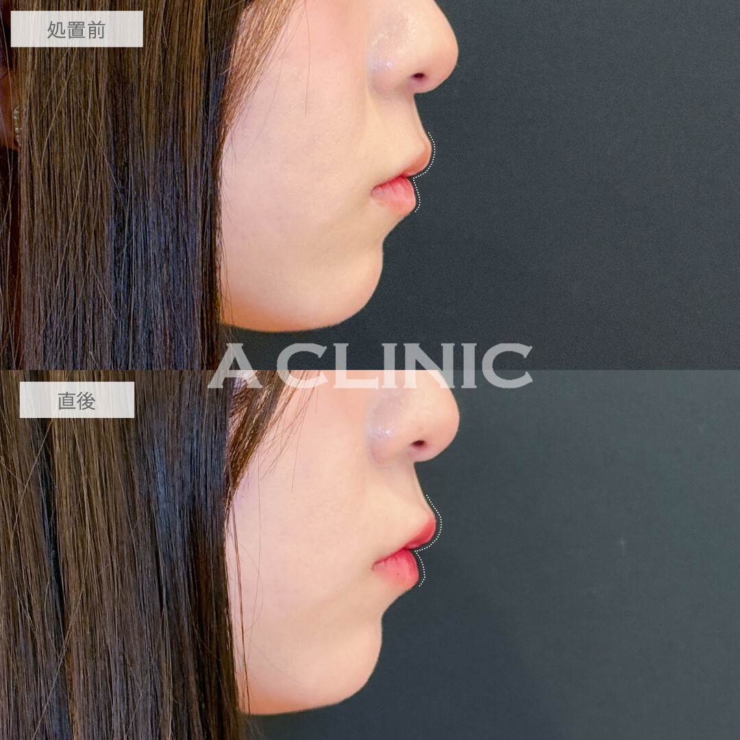 スマイルリップでちゅるんなM字リップになれました！こちら処置前と直後の症例です(20代女性)