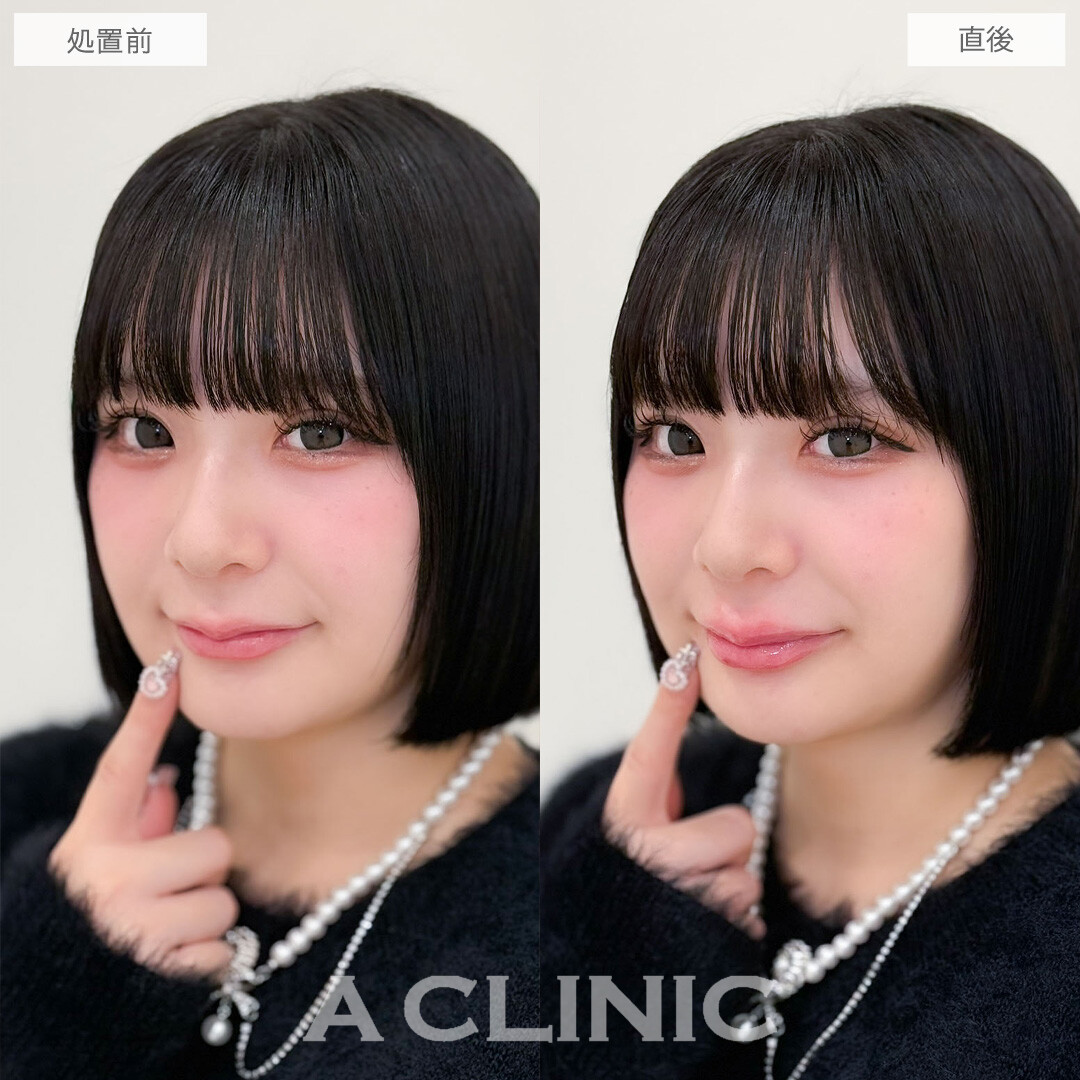 スマイルリップでぷるぷるM字リップになりました！こちら処置前と直後の症例です(20代女性)