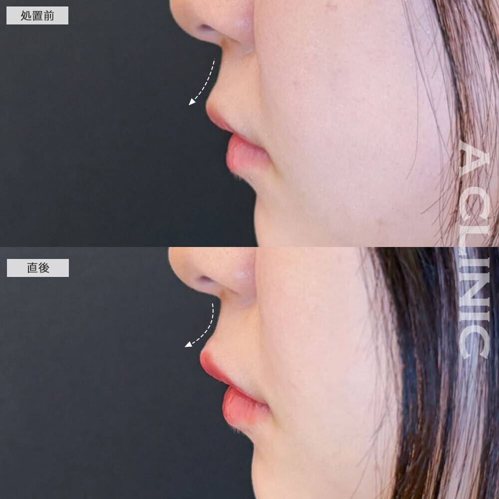 スマイルリップで形と厚さを整えて可愛い唇に！こちら処置前と直後の症例です(10代女性)