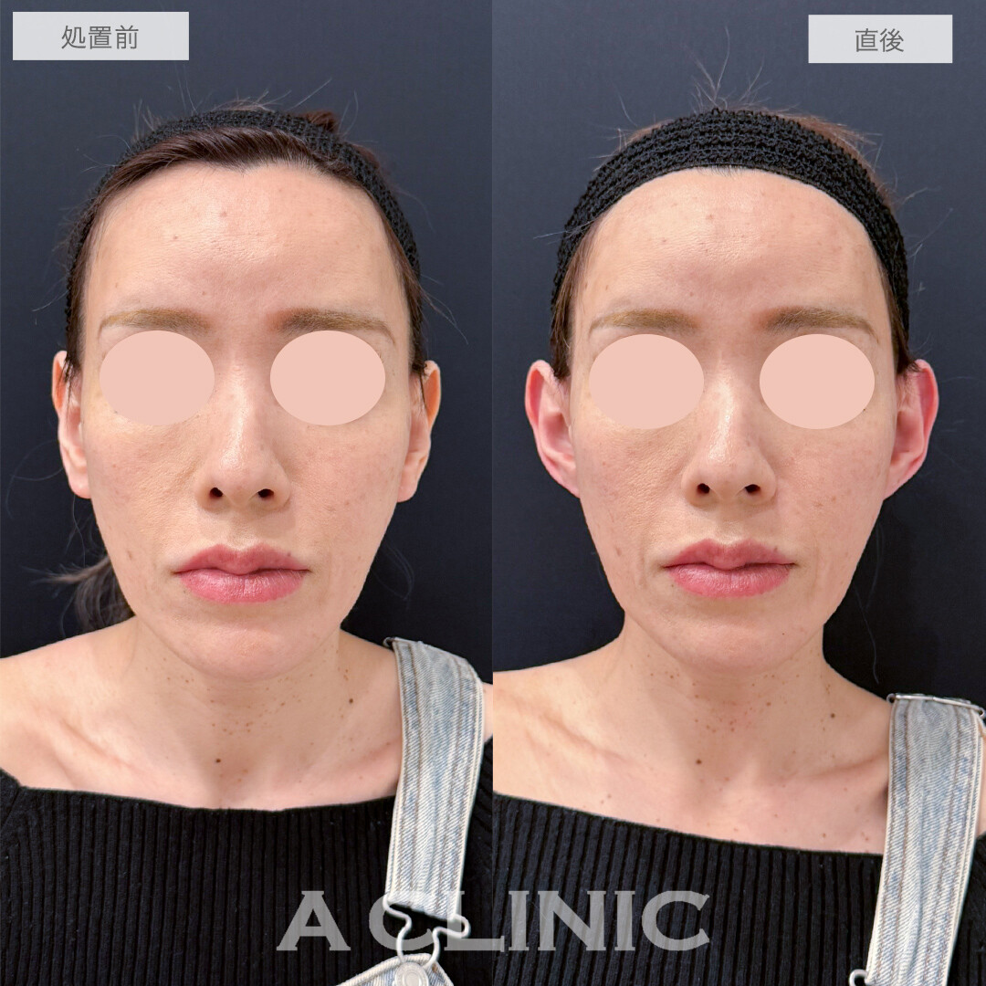 耳たぶ縮小術と立ち耳ヒアルロン酸注入で理想の形の耳に！処置前と直後の症例です(40代女性)