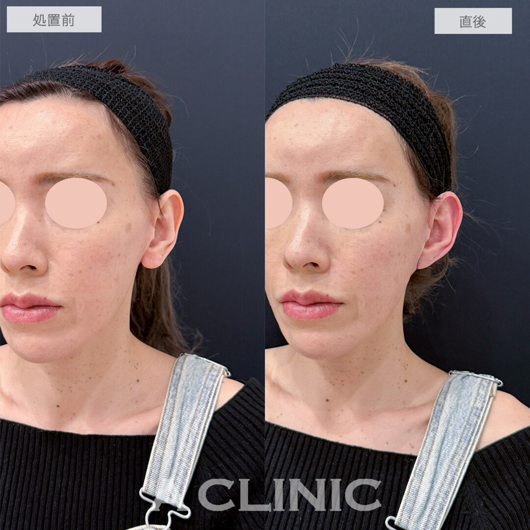 耳たぶ縮小術と立ち耳ヒアルロン酸注入で理想の形の耳に！処置前と直後の症例です(40代女性)