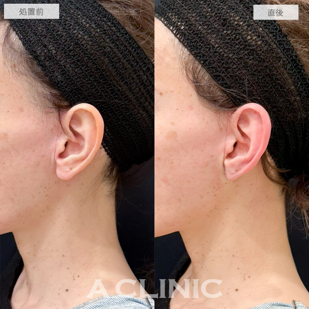 耳たぶ縮小術と立ち耳ヒアルロン酸注入で理想の形の耳に！処置前と直後の症例です(40代女性)