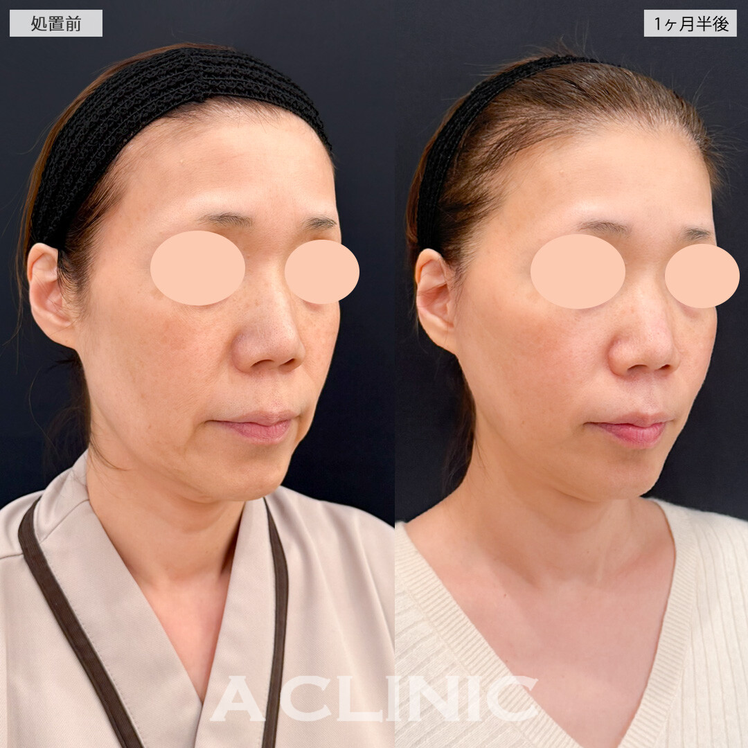 1day小顔脂肪吸引とA式たるみ切開で将来たるみにくい顔を目指せます！処置前と1ヶ月半後の症例です(50代女性)