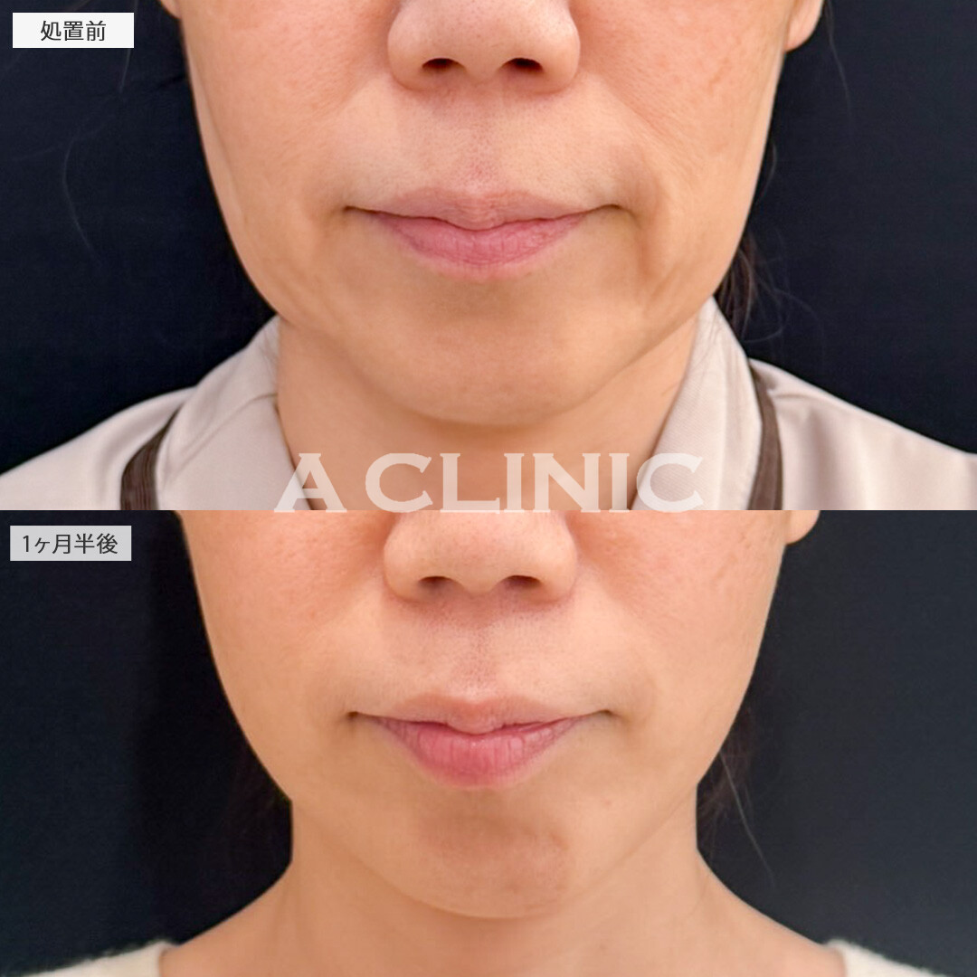 1day小顔脂肪吸引とA式たるみ切開で将来たるみにくい顔を目指せます！処置前と1ヶ月半後の症例です(50代女性)