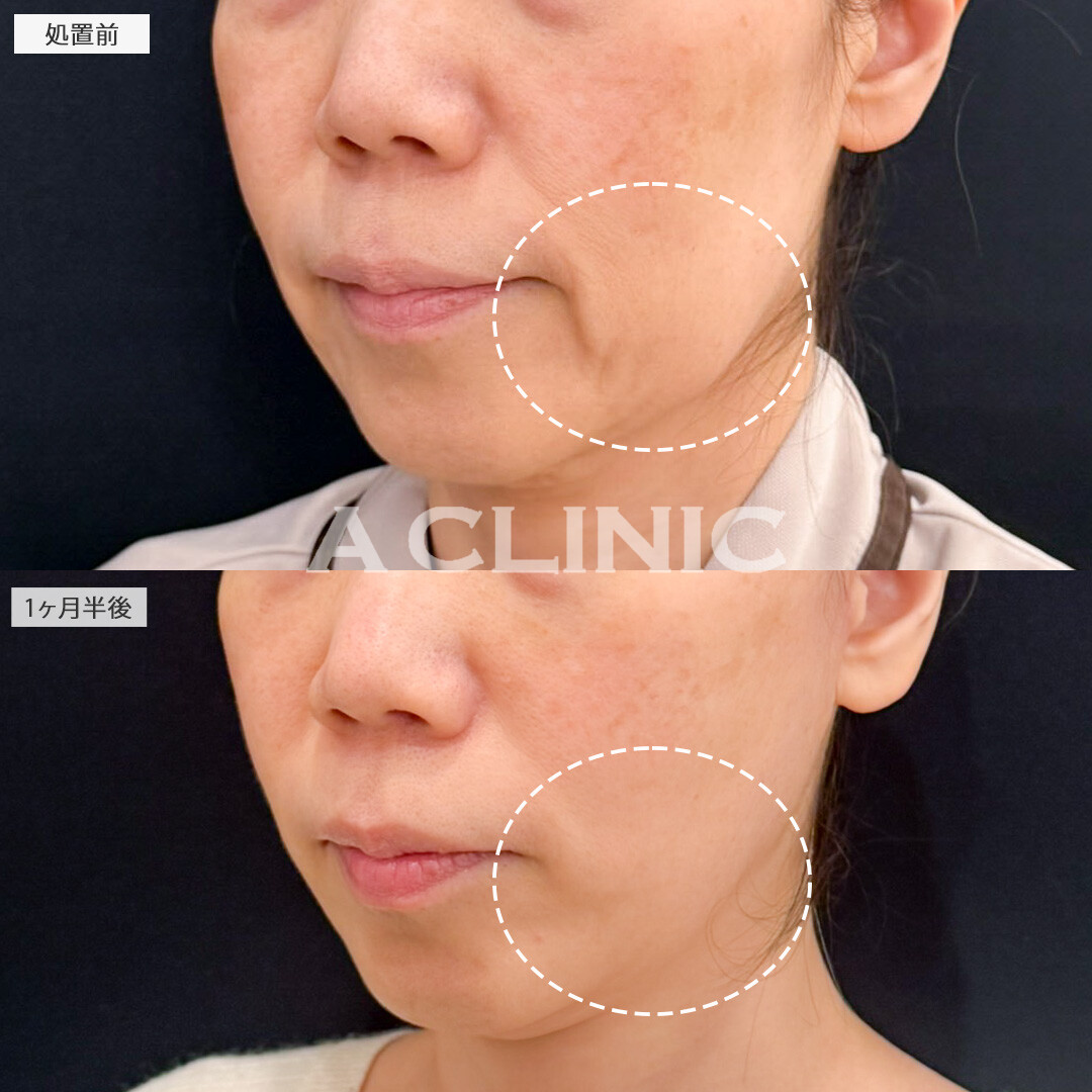 1day小顔脂肪吸引とA式たるみ切開で将来たるみにくい顔を目指せます！処置前と1ヶ月半後の症例です(50代女性)