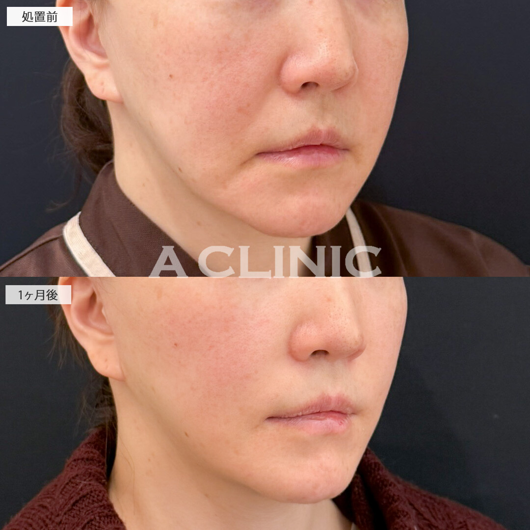 A式美肌たるみ切開とほうれい線のPRP血小板療法で顔周りのたるみやほうれい線が一気に解消！処置前と1ヶ月後の症例です(50代女性)