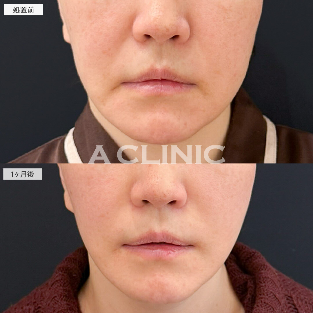 A式美肌たるみ切開とほうれい線のPRP血小板療法で顔周りのたるみやほうれい線が一気に解消！処置前と1ヶ月後の症例です(50代女性)