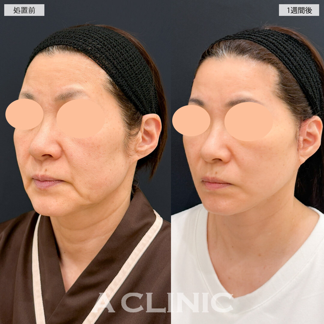 A式たるみ切開で輪郭のもたつきとほうれい線が同時に改善できました！処置前と1週間後の症例です(60代女性)