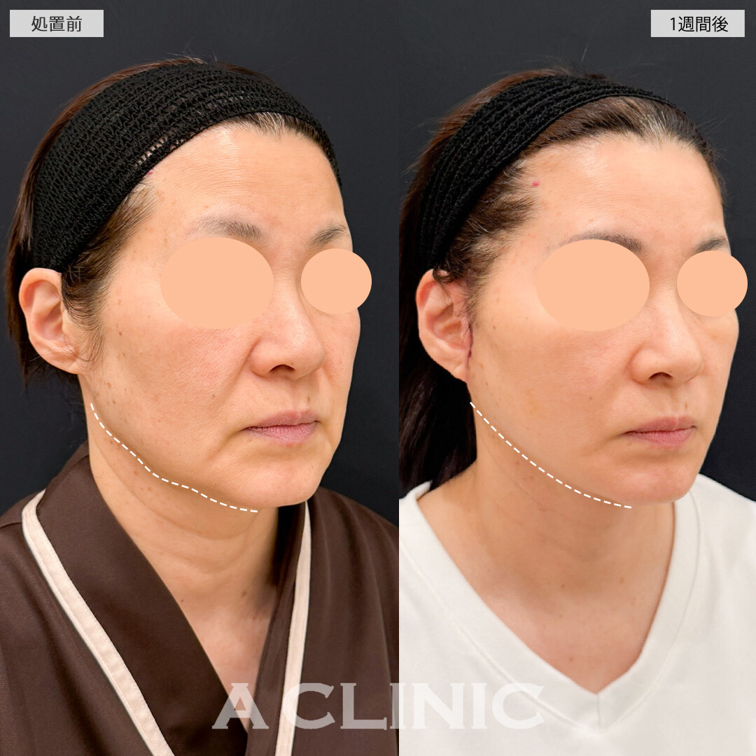 A式たるみ切開で輪郭のもたつきとほうれい線が同時に改善できました！処置前と1週間後の症例です(60代女性)