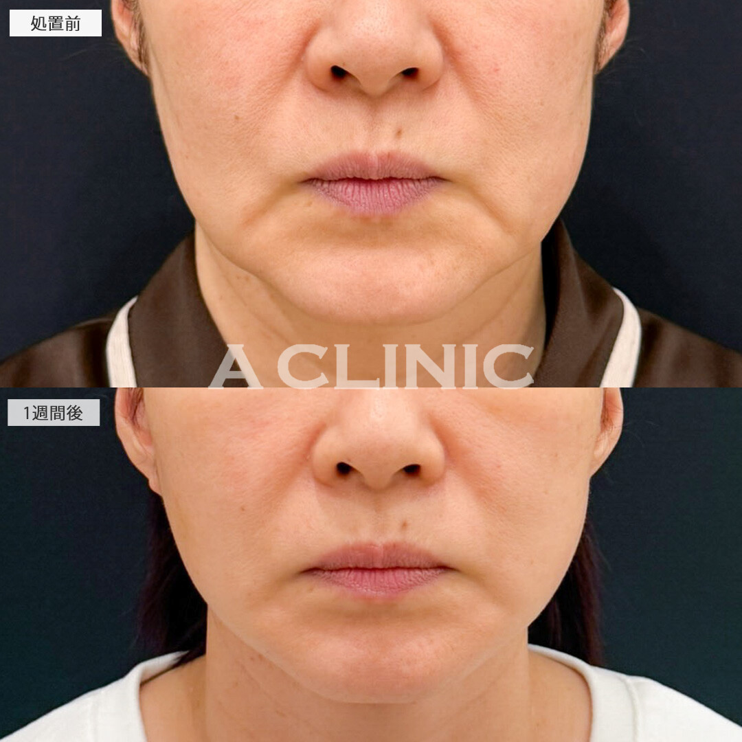 A式たるみ切開で輪郭のもたつきとほうれい線が同時に改善できました！処置前と1週間後の症例です(60代女性)