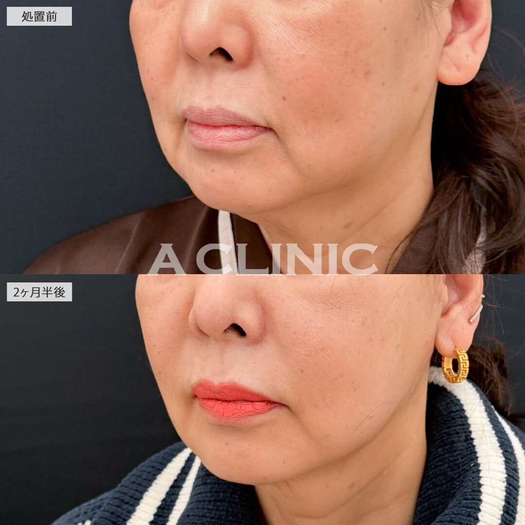 【直後の傷跡あり】A式ナゾラリフトと1day小顔脂肪吸引でたるみと脂肪をなくして年齢を感じさせない小顔に！こちら処置前と2か月半後の症例です(60代女性)