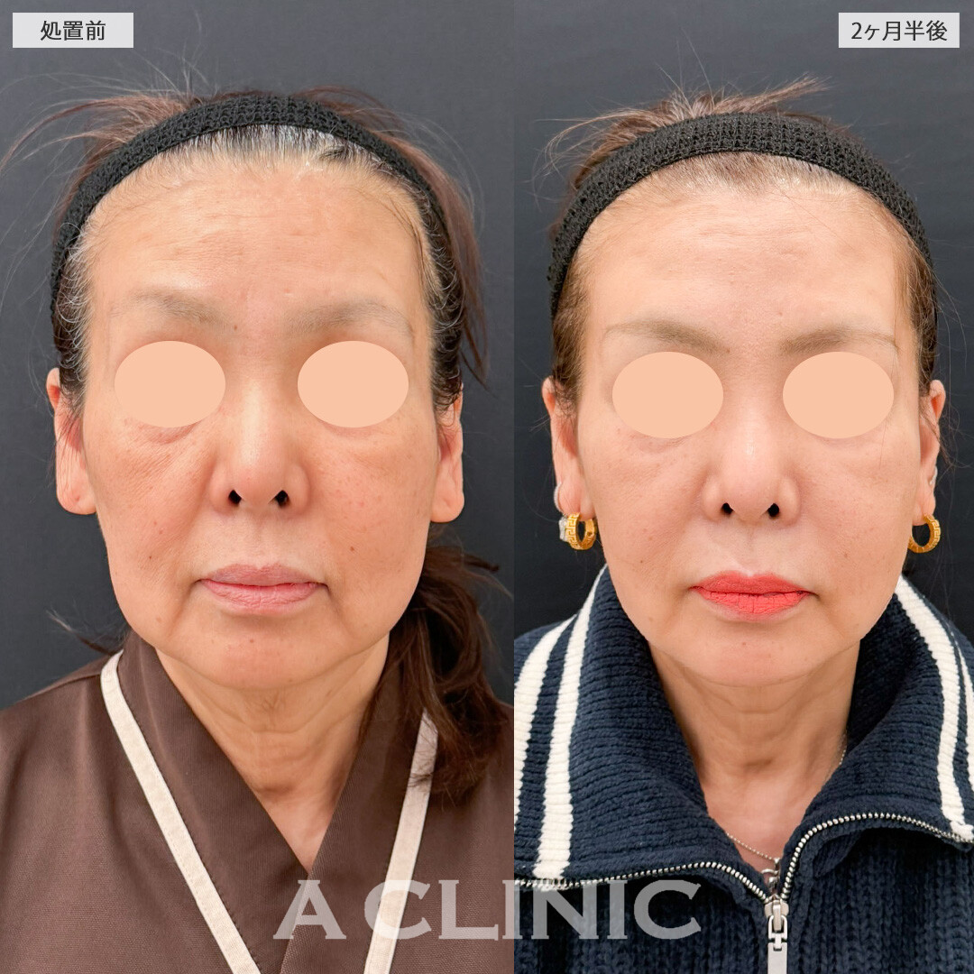 【直後の傷跡あり】A式ナゾラリフトと1day小顔脂肪吸引でたるみと脂肪をなくして年齢を感じさせない小顔に！こちら処置前と2か月半後の症例です(60代女性)