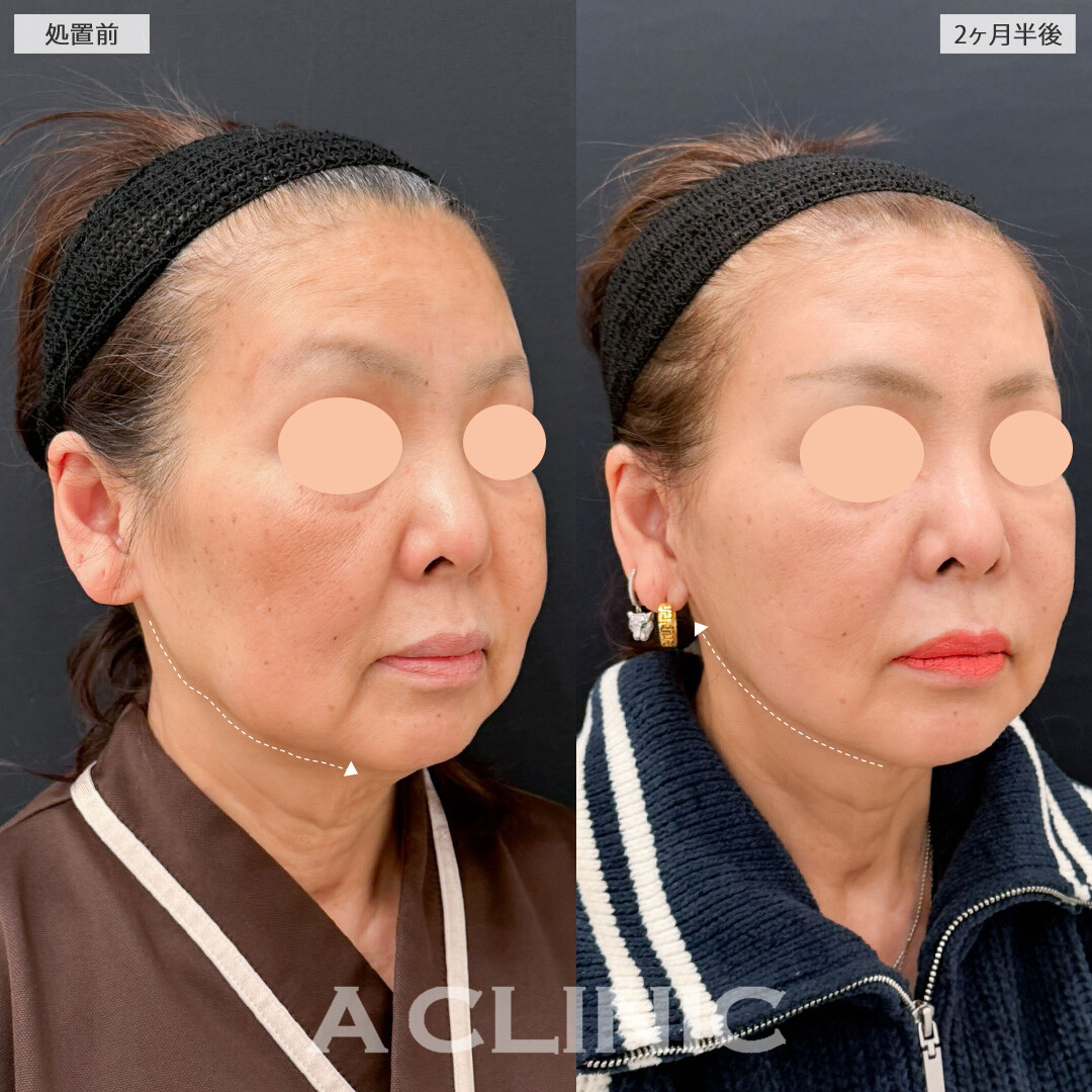 【直後の傷跡あり】A式ナゾラリフトと1day小顔脂肪吸引でたるみと脂肪をなくして年齢を感じさせない小顔に！こちら処置前と2か月半後の症例です(60代女性)