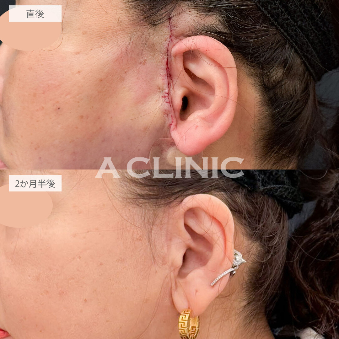 【直後の傷跡あり】A式ナゾラリフトと1day小顔脂肪吸引でたるみと脂肪をなくして年齢を感じさせない小顔に！こちら処置前と2か月半後の症例です(60代女性)