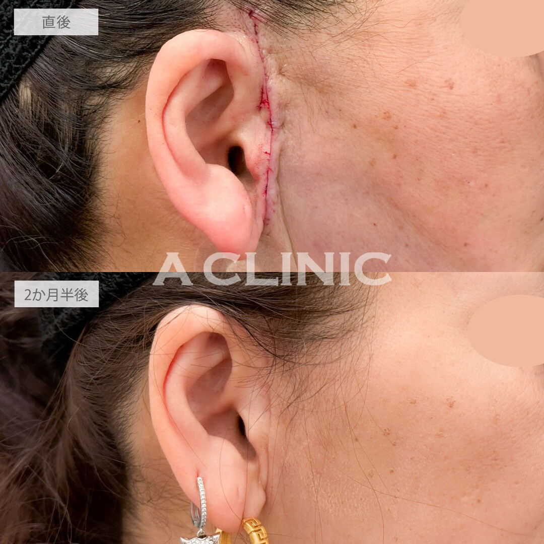 【直後の傷跡あり】A式ナゾラリフトと1day小顔脂肪吸引でたるみと脂肪をなくして年齢を感じさせない小顔に！こちら処置前と2か月半後の症例です(60代女性)