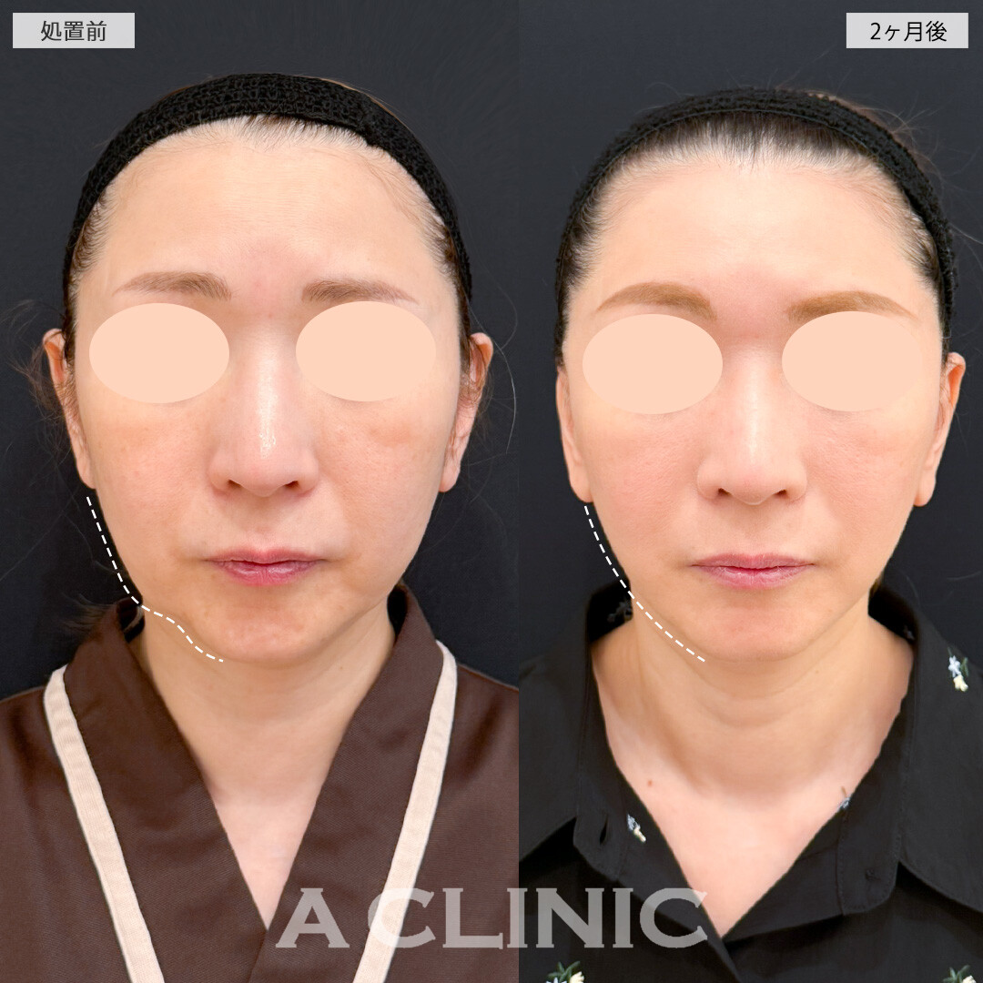 1day小顔脂肪吸引とA式たるみ切開で年齢とともに目立つフェイスラインのもたつきも全く気にならなくなりました！処置前と2ヶ月後の症例です(50代女性)