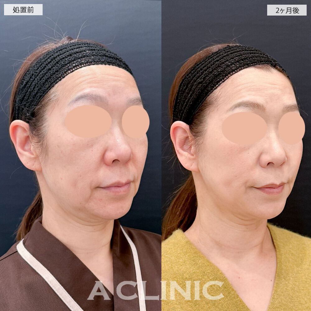 A式たるみ切開でブルドッグ顔になりやすい口横のたるみ改善！こちら処置前と2ヶ月後の症例です(50代女性)