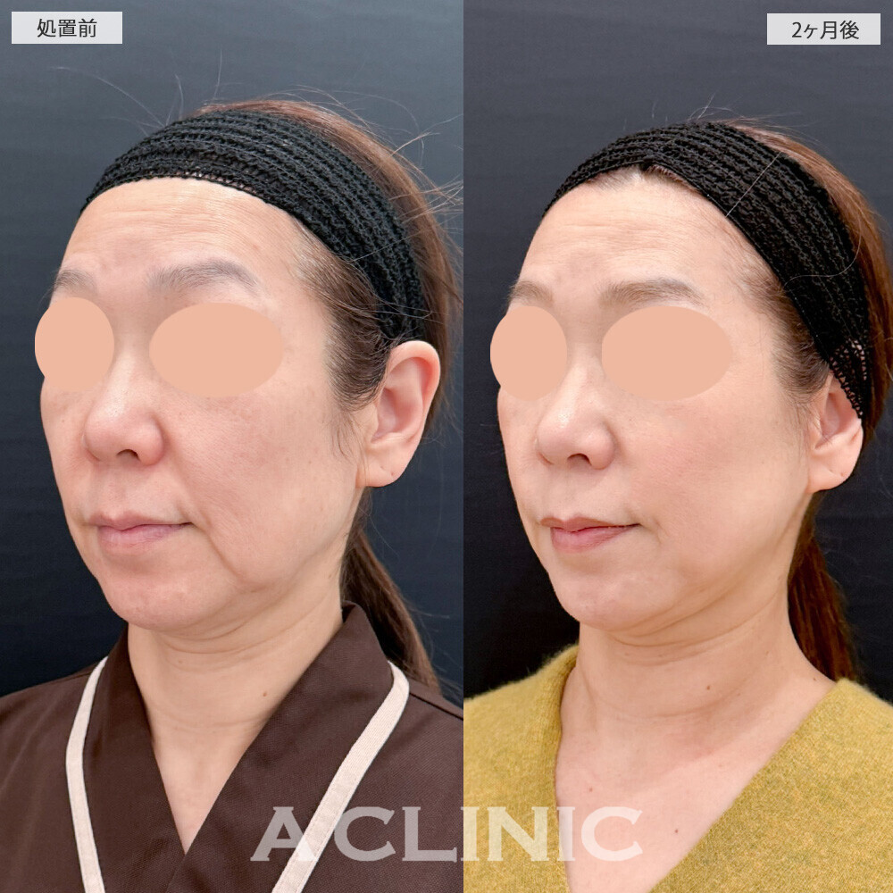 A式たるみ切開でブルドッグ顔になりやすい口横のたるみ改善！こちら処置前と2ヶ月後の症例です(50代女性)