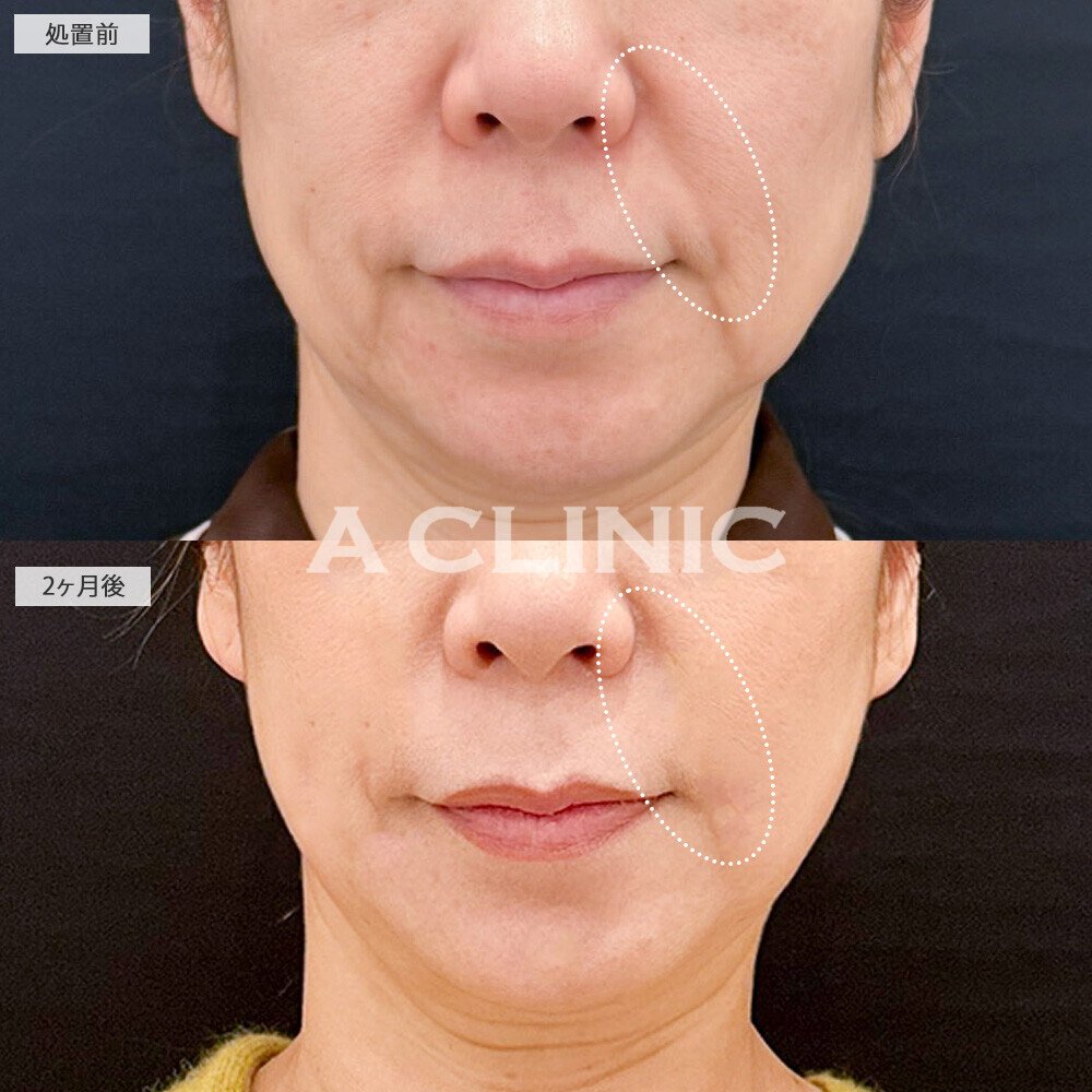 A式たるみ切開でブルドッグ顔になりやすい口横のたるみ改善！こちら処置前と2ヶ月後の症例です(50代女性)
