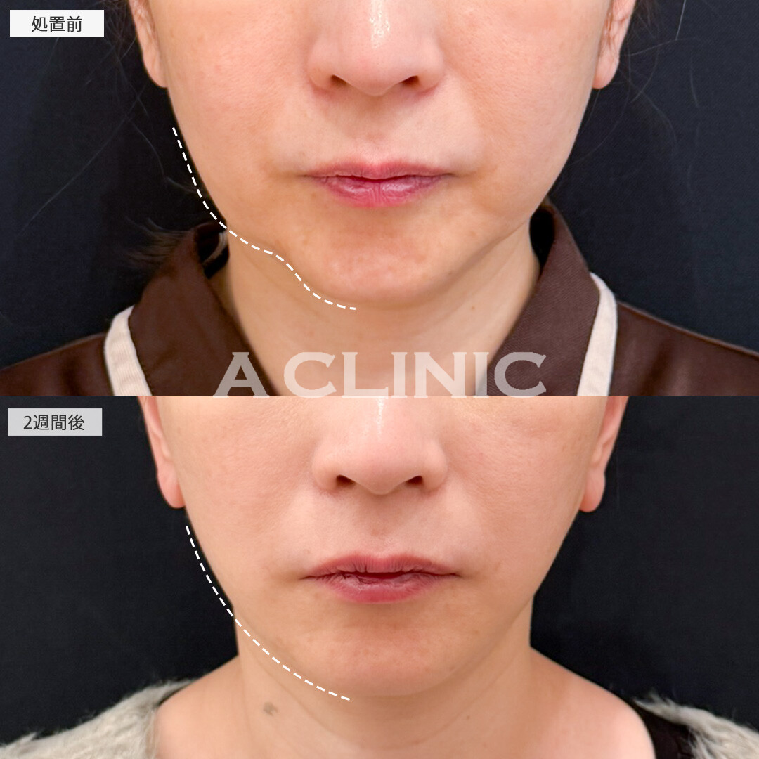 1day小顔脂肪吸引とA式たるみ切開でフェイスラインがしっかり引きあがり若返り効果抜群！処置前と2週間後の症例です(50代女性)