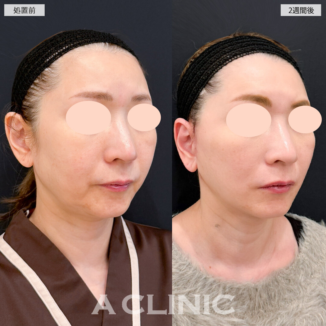 1day小顔脂肪吸引とA式たるみ切開でフェイスラインがしっかり引きあがり若返り効果抜群！処置前と2週間後の症例です(50代女性)