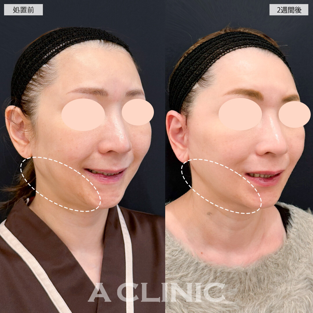 1day小顔脂肪吸引とA式たるみ切開でフェイスラインがしっかり引きあがり若返り効果抜群！処置前と2週間後の症例です(50代女性)