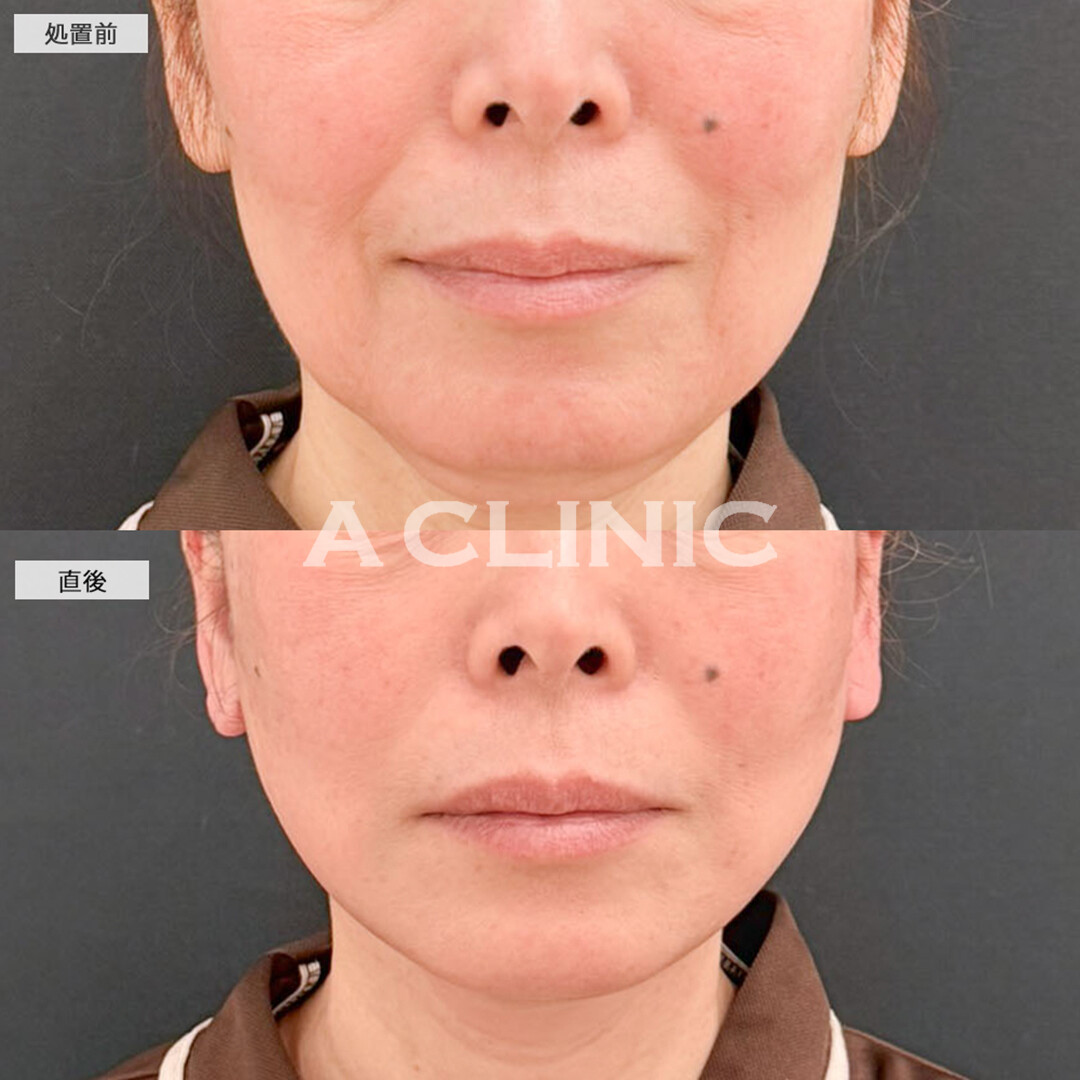 A式たるみ切開と1day小顔脂肪吸引で直後から皮膚が引きあがり二重アゴも解消され若返り！こちら処置前と直後の症例です(50代女性)