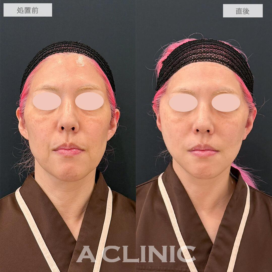A式たるみ切開で圧倒的な若返り効果！処置前と直後の症例です(50代女性)