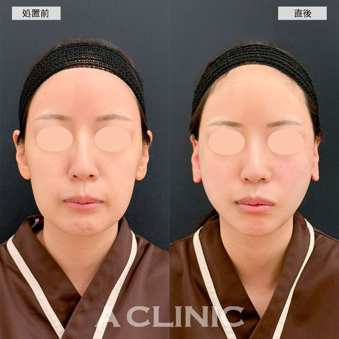 1day小顔脂肪吸引とA式たるみ切開なら直後から腫れ無しで小顔になれます！こちら処置前と直後の症例です(30代女性)