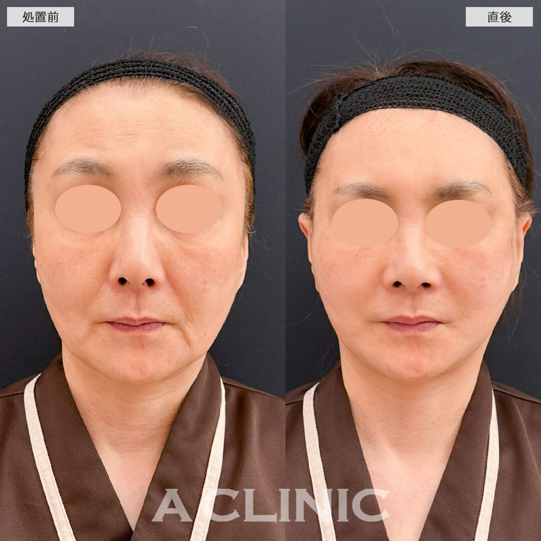 A式たるみ切開でたるみを強力に引き上げてマイナス10才見え！こちら処置前と直後の症例です(60代女性)