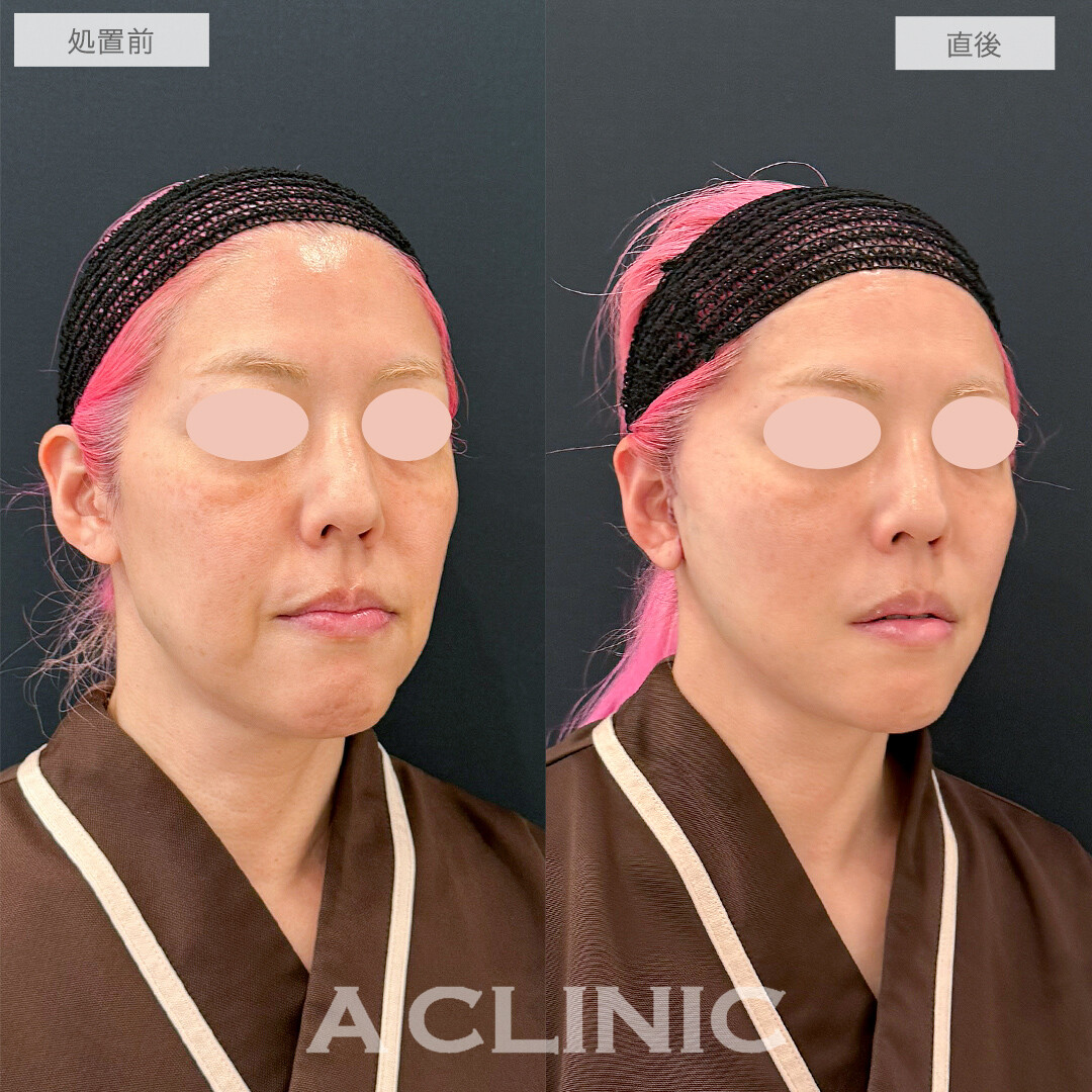 A式たるみ切開で圧倒的な若返り効果！処置前と直後の症例です(50代女性)