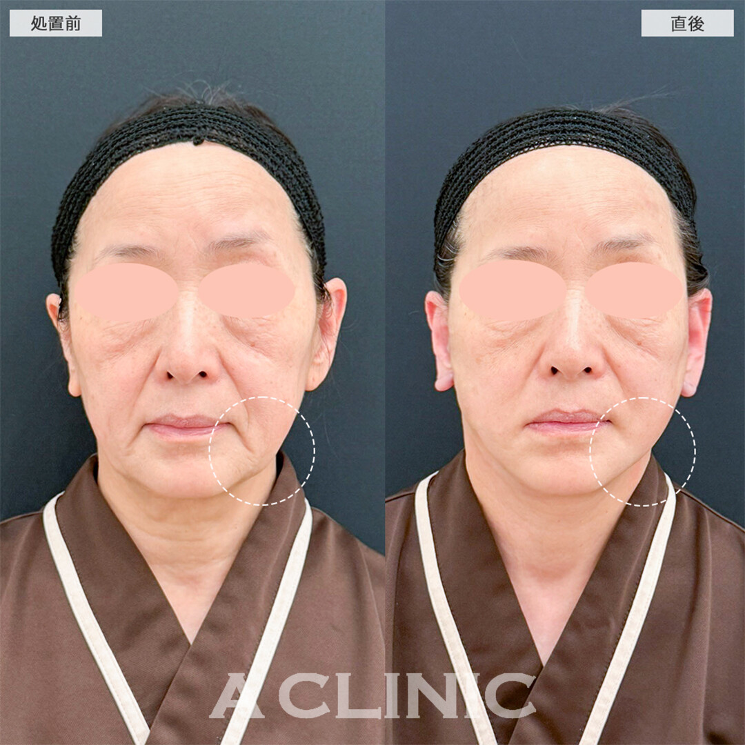 A式たるみ切開は直後からたるみが引き上がります！こちら処置前と直後の症例です(60代女性)