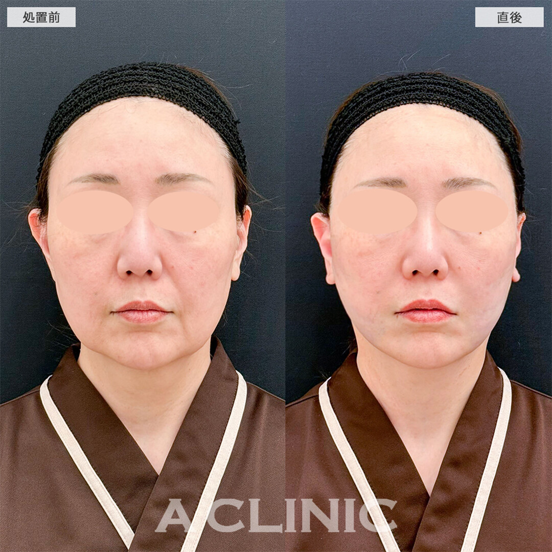 A式たるみ切開と1day小顔脂肪吸引でたるみのない輪郭になりました！こちら処置前と直後の症例です(50代女性)