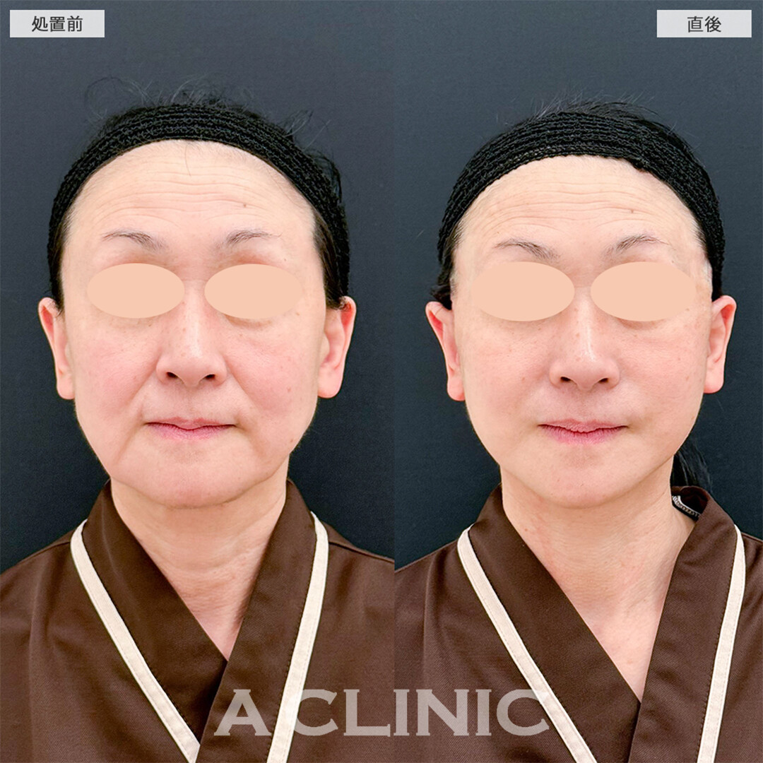 A式たるみ切開は長年の悩みを解消できます！こちら処置前と直後の症例です(50代女性)