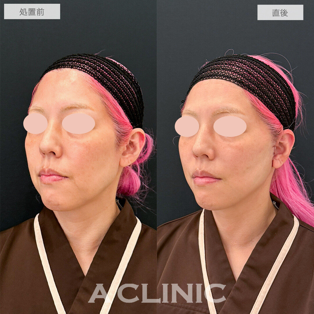 A式たるみ切開で圧倒的な若返り効果！処置前と直後の症例です(50代女性)