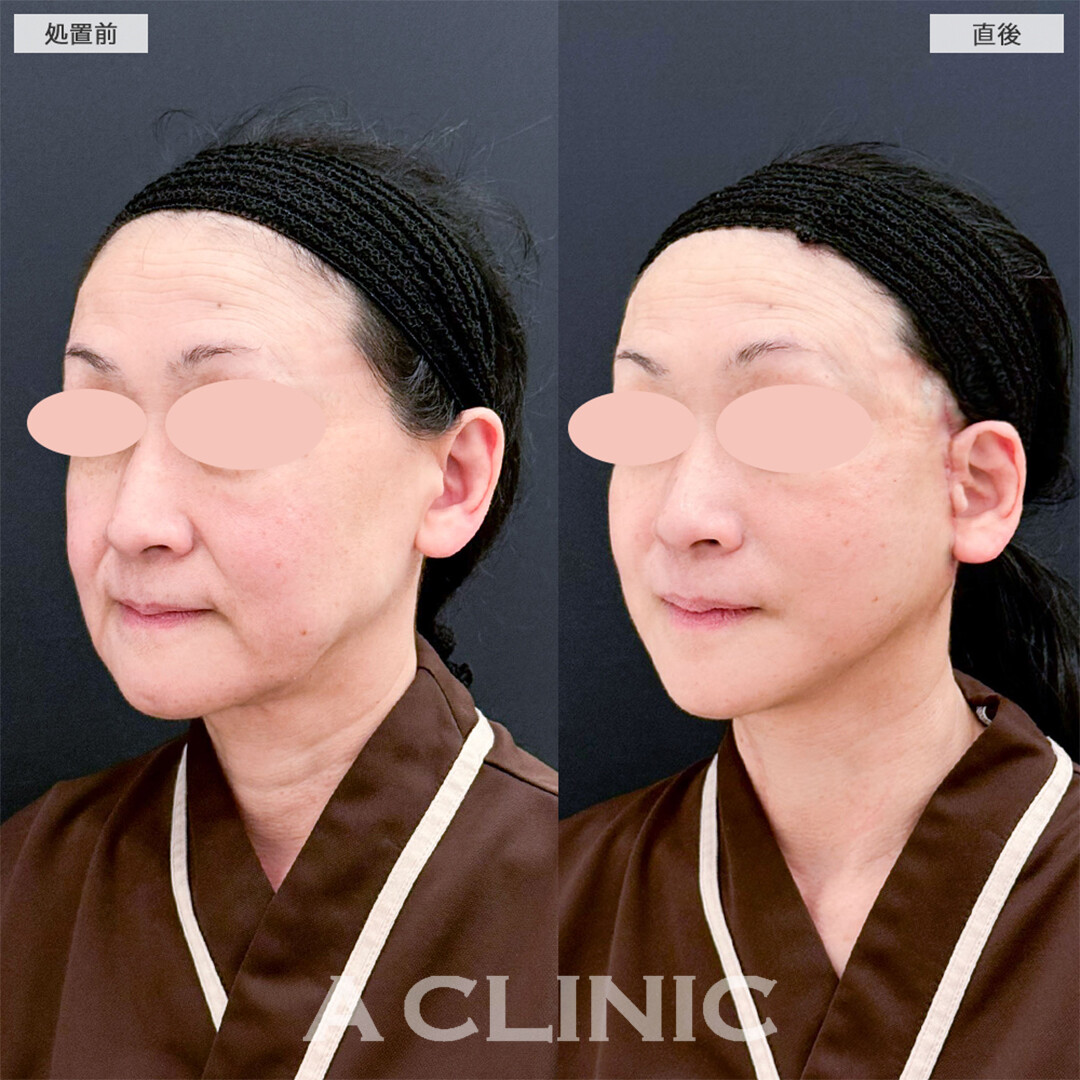 A式たるみ切開は長年の悩みを解消できます！こちら処置前と直後の症例です(50代女性)