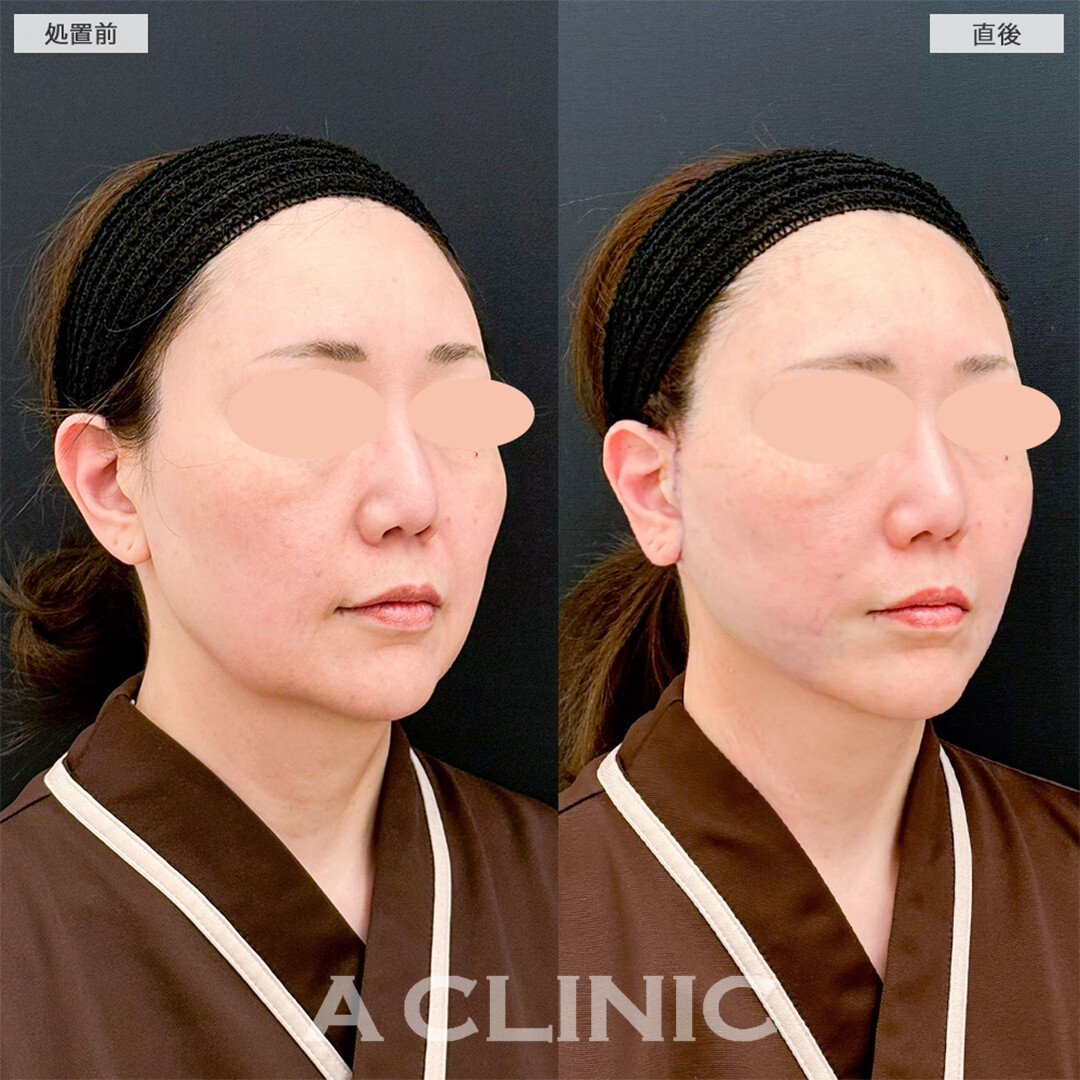 A式たるみ切開と1day小顔脂肪吸引でたるみのない輪郭になりました！こちら処置前と直後の症例です(50代女性)