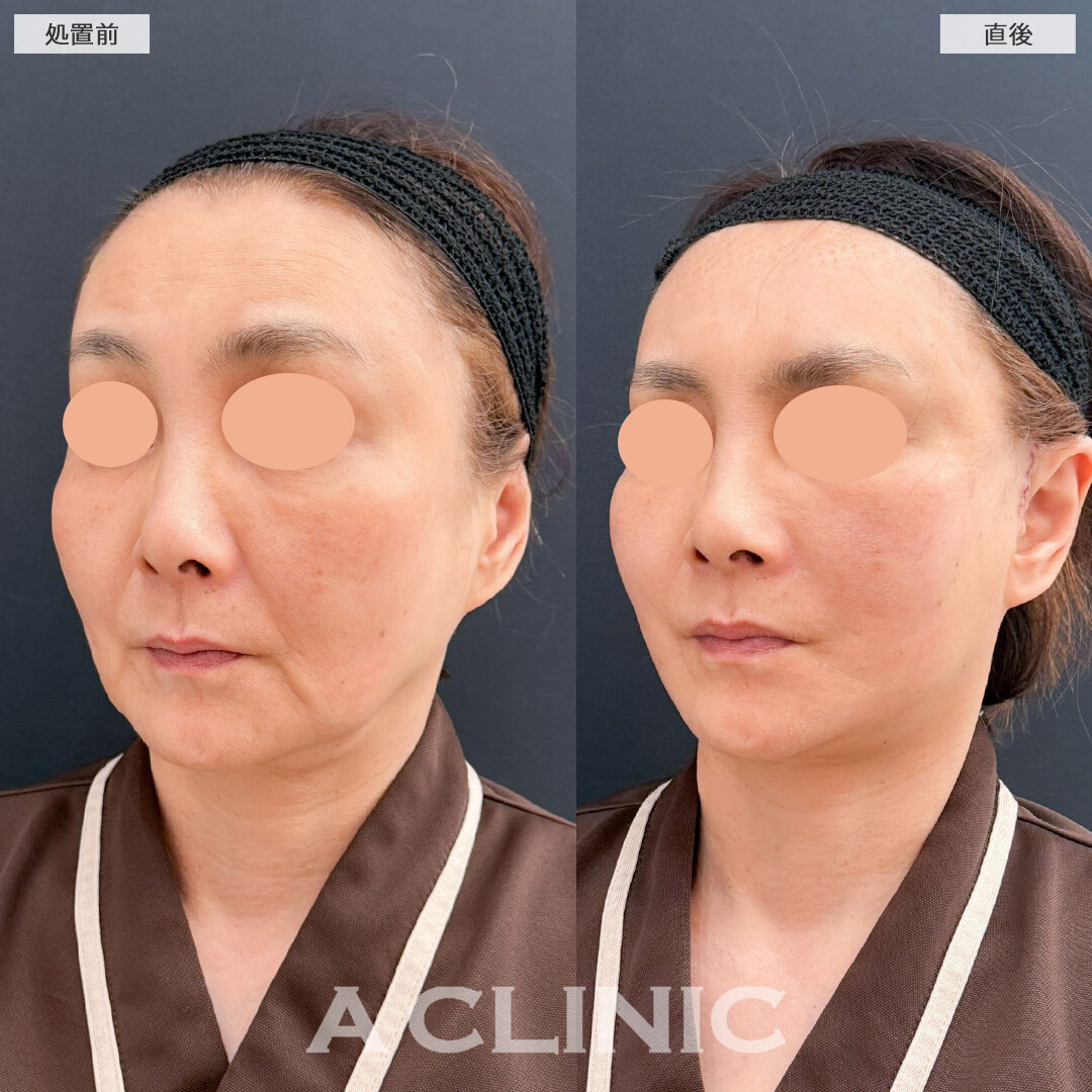 A式たるみ切開でたるみを強力に引き上げてマイナス10才見え！こちら処置前と直後の症例です(60代女性)