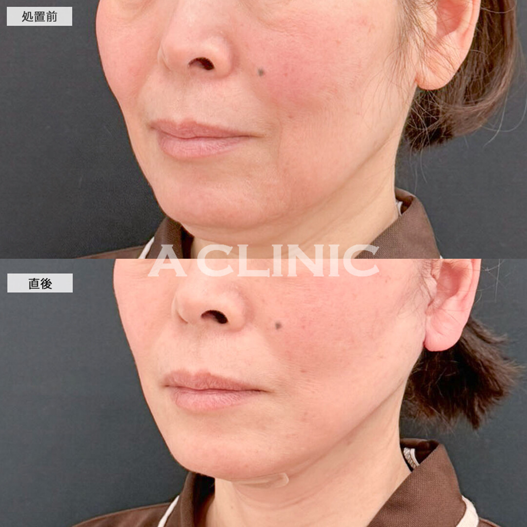 A式たるみ切開と1day小顔脂肪吸引で直後から皮膚が引きあがり二重アゴも解消され若返り！こちら処置前と直後の症例です(50代女性)