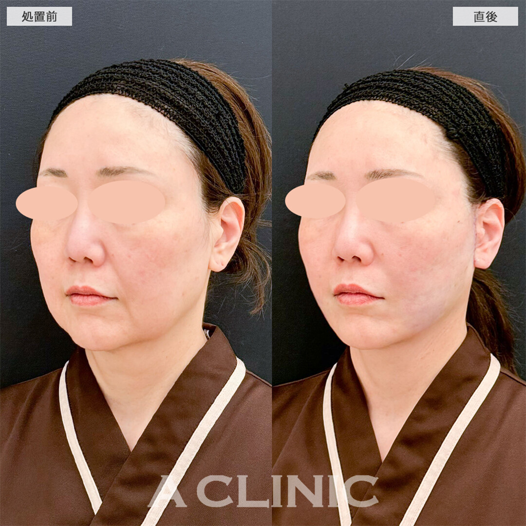 A式たるみ切開と1day小顔脂肪吸引でたるみのない輪郭になりました！こちら処置前と直後の症例です(50代女性)