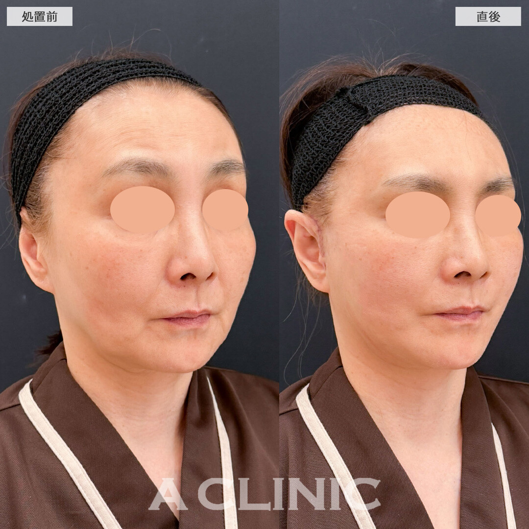 A式たるみ切開でたるみを強力に引き上げてマイナス10才見え！こちら処置前と直後の症例です(60代女性)