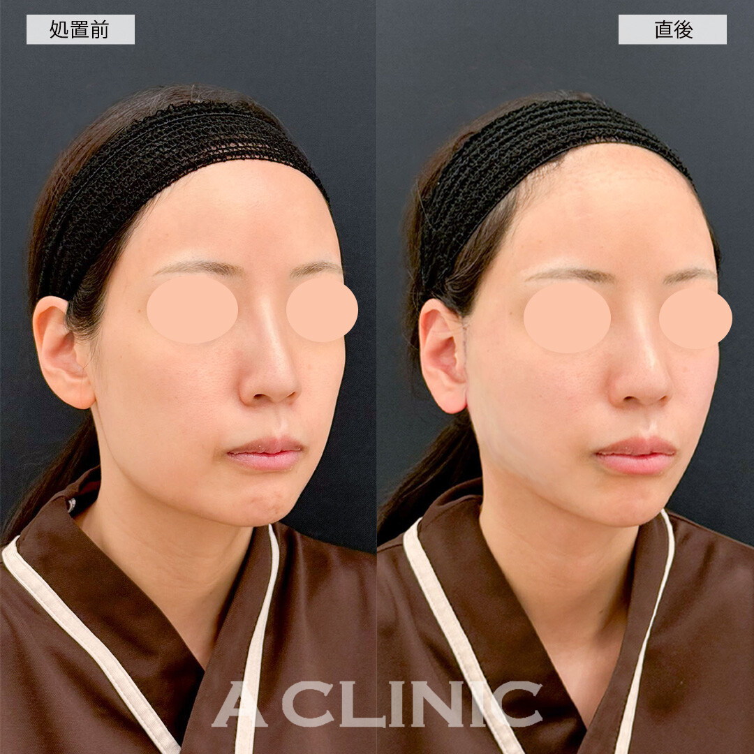 1day小顔脂肪吸引とA式たるみ切開なら直後から腫れ無しで小顔になれます！こちら処置前と直後の症例です(30代女性)