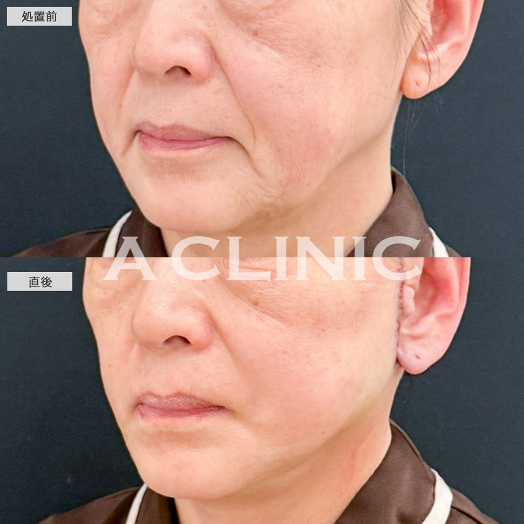 A式たるみ切開は直後からたるみが引き上がります！こちら処置前と直後の症例です(60代女性)