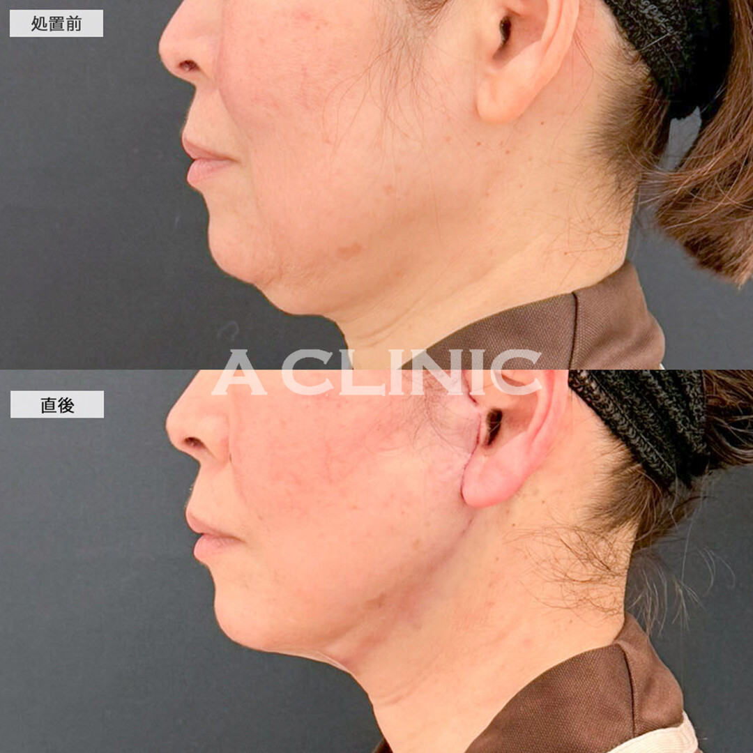 A式たるみ切開と1day小顔脂肪吸引で直後から皮膚が引きあがり二重アゴも解消され若返り！こちら処置前と直後の症例です(50代女性)